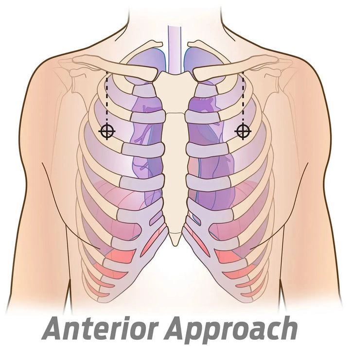 14ga Decompressioneula venttiilillä – Ammattilaisen valinta paineilmarinnan hoitoon. - Medrescue Gear