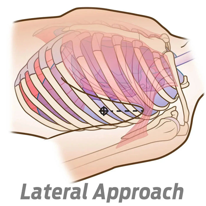 14ga Decompressioneula venttiilillä – Ammattilaisen valinta paineilmarinnan hoitoon. - Medrescue Gear